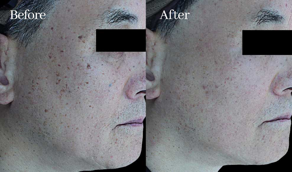 슬로아 시그니처 5