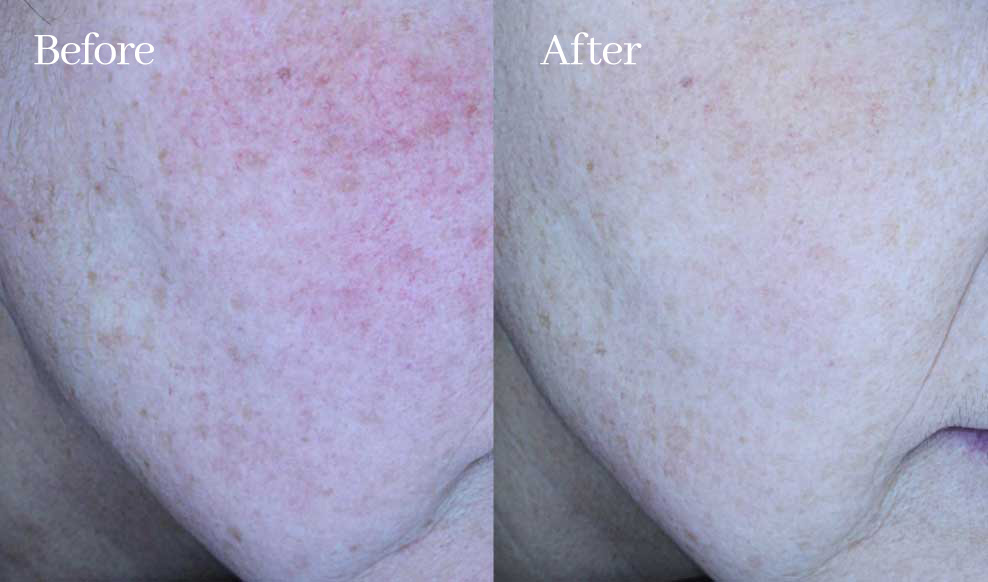 슬로아 시그니처 6